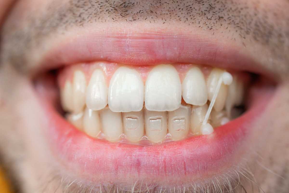 invisalign-rubber-bands-the-complete-guide-to-bite-correction