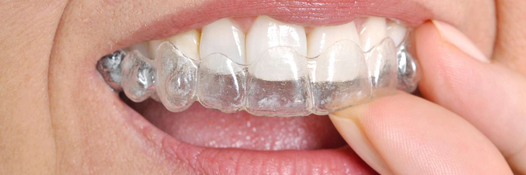 Invisalign Dedham | patient putting in top aligner
