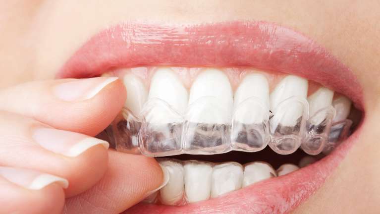 Invisalign vs. Traditional Braces: Making the Right Choice for a