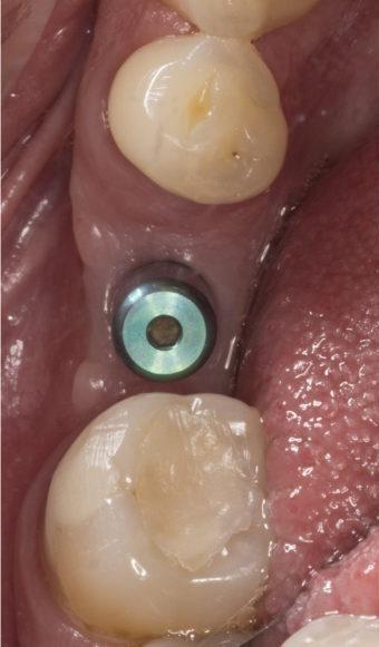 before photo dental implant dedham