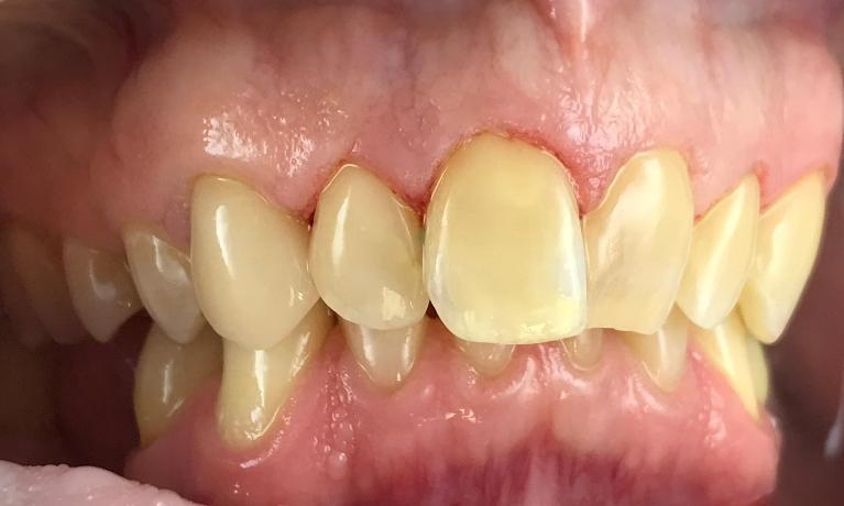 After photo of dental restorations