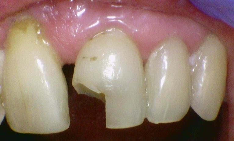 Chipped tooth before photo | emergency dentist hyde park